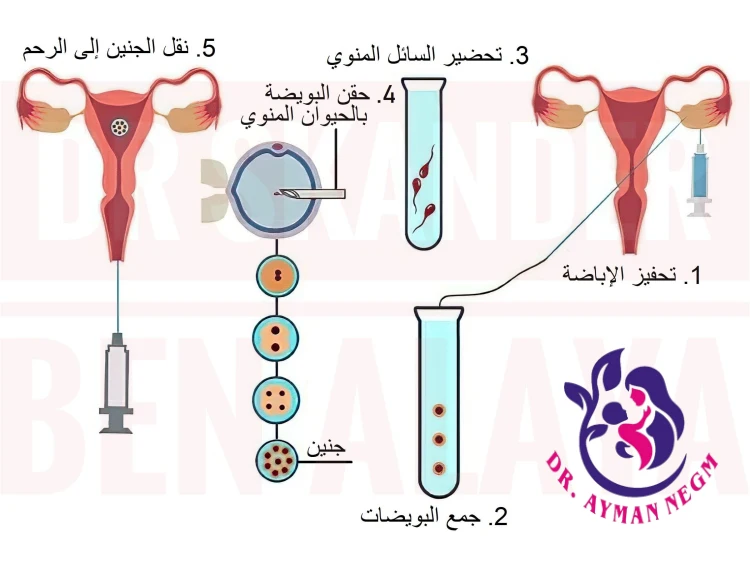 اهمية الحقن المجهرى فى علاج العقم