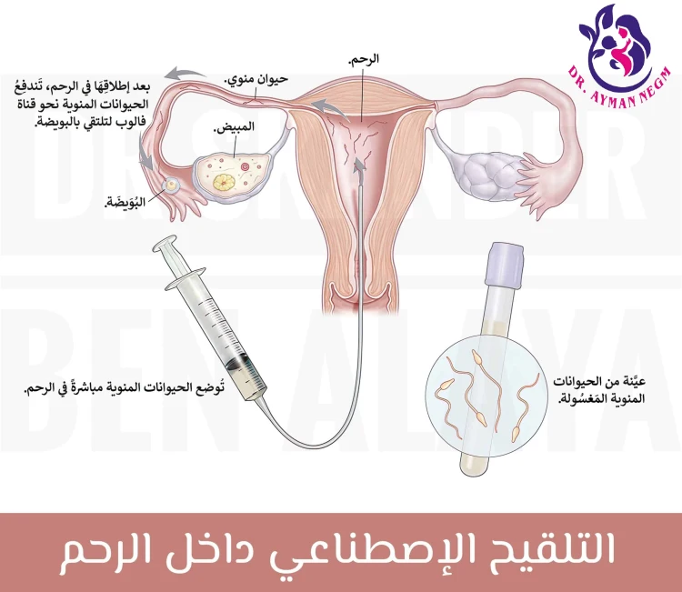 ما هو التلقيح الصناعي وكيف يتم