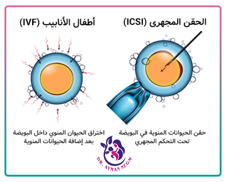 ما هو ICSI؟
