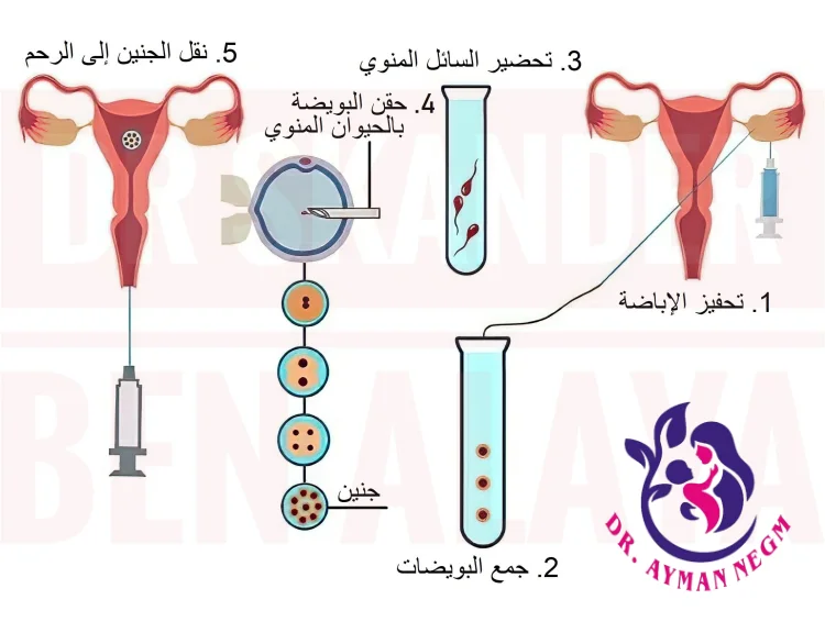 كيف يتم حقن مجهرى  -خطوة بخطوة؟