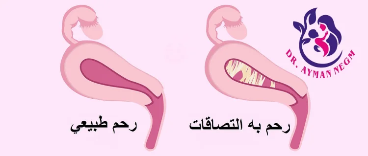 ما هي التصاقات الرحم