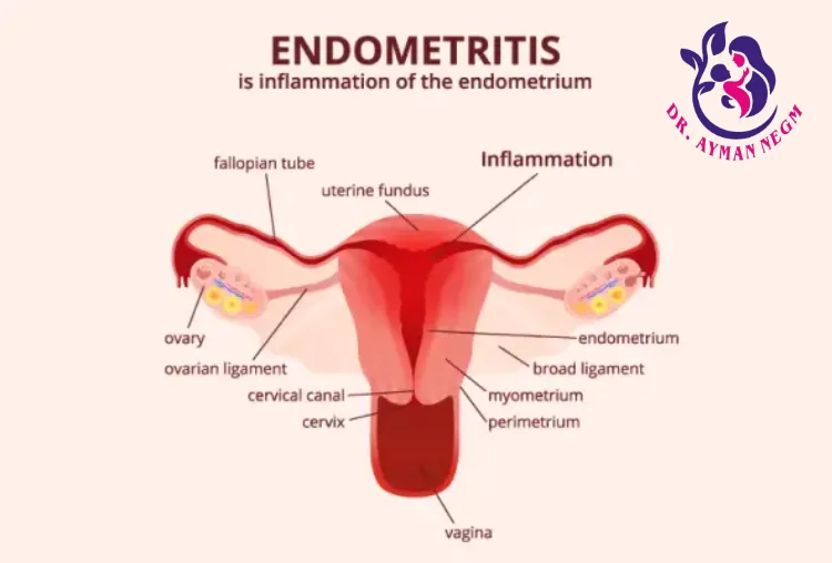 Endometriose التهاب الغشاء المخاطي (الإندوميتريوز)