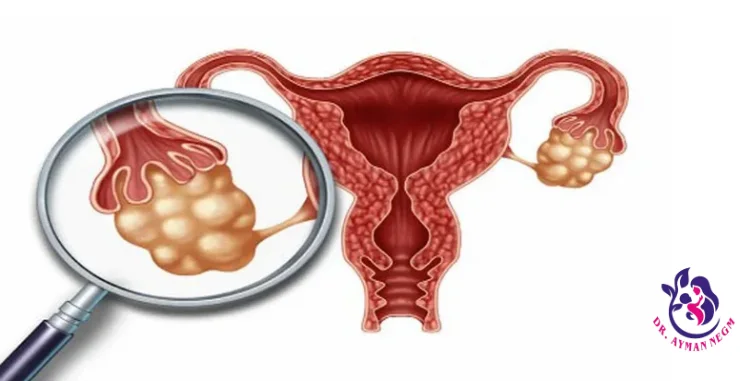 ما هو تكيس المبايض؟
