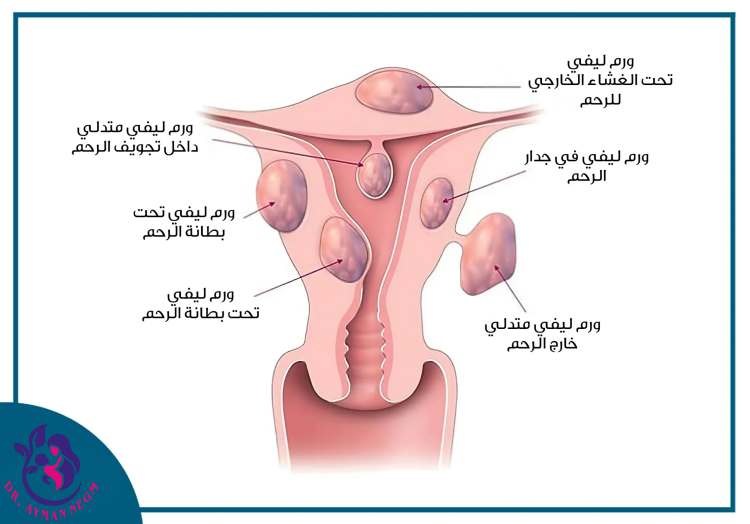 أنواع الورم الليفي