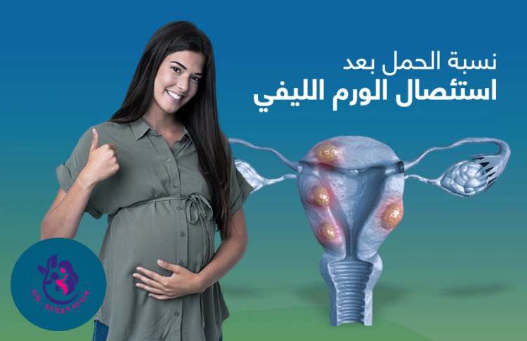 نسبة الحمل بعد استئصال الورم الليفي