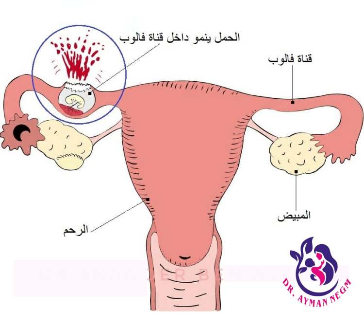 هل يمكن الحمل بدون قنوات فالوب؟