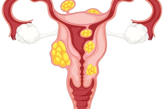 استئصال الرحم بسبب الورم الليفي