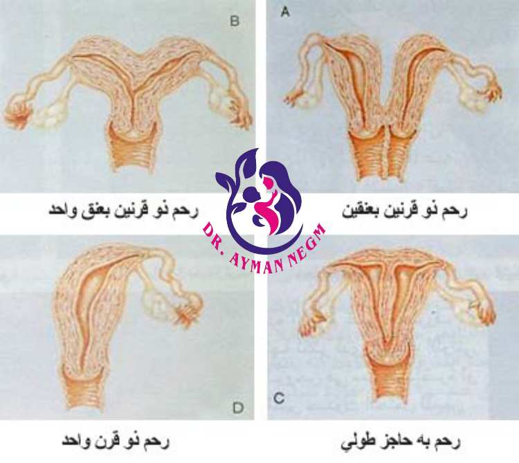 انواع الحاجز الرحمي