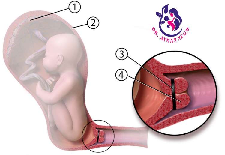 حركة الجنين بعد ربط عنق الرحم