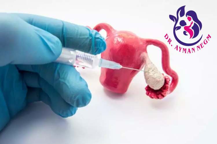 حقن البلازما للمبيض