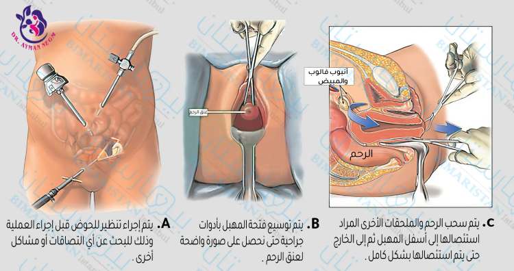 عملية استئصال الرحم بالصور