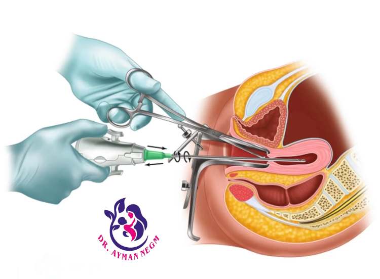 كم تستغرق عملية استئصال الرحم؟