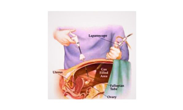 استئصال الرحم بالمنظار من البطن