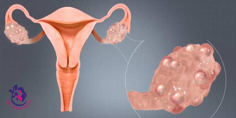 أسباب تكون كيس ماء على المبيض