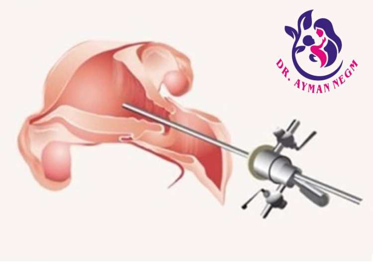 ازالة الحاجز الرحمى بالمنظار