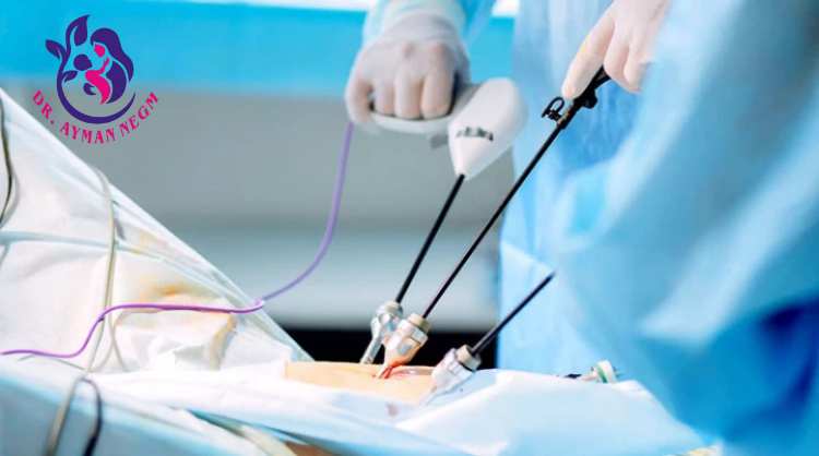  استئصال بطانة الرحم المهاجرة بالمنظار 