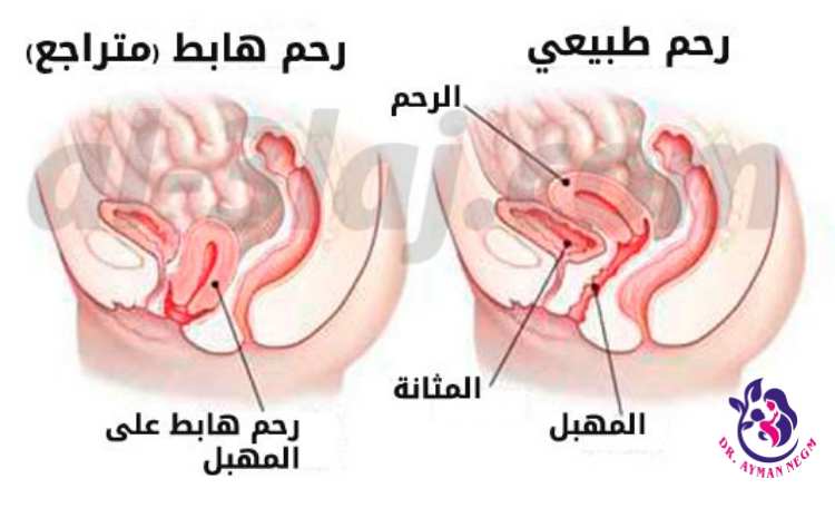 اعراض سقوط الرحم