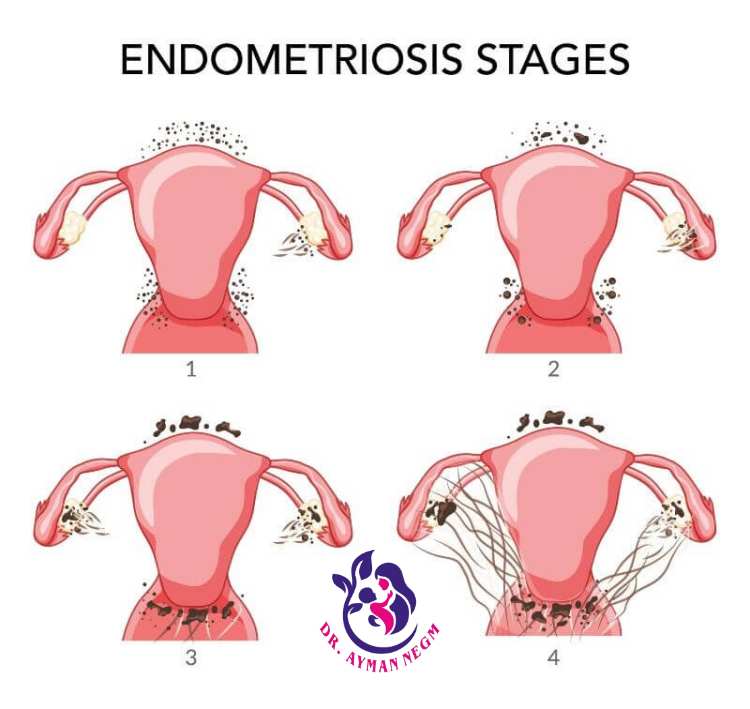 درجات بطانة الرحم المهاجرة 