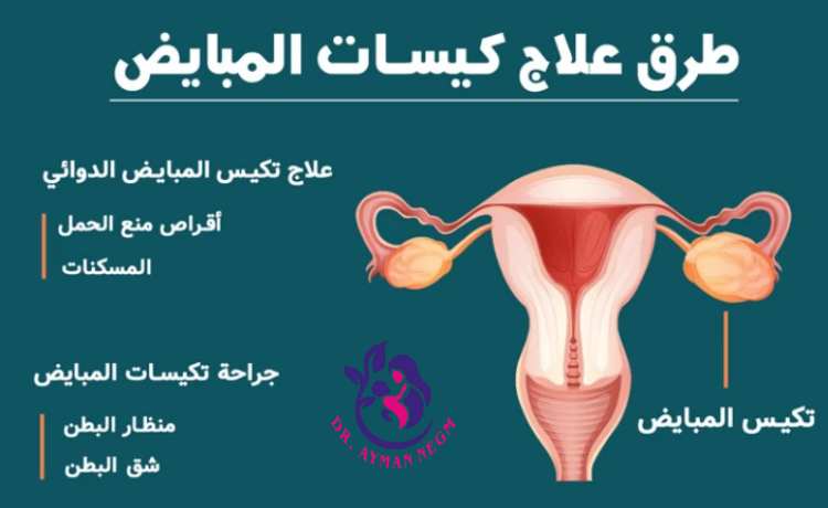 طرق علاج كيس على المبيض