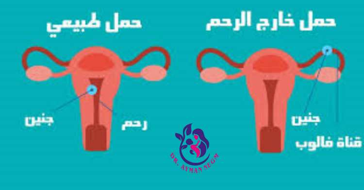 كم يستمر الحمل خارج الرحم