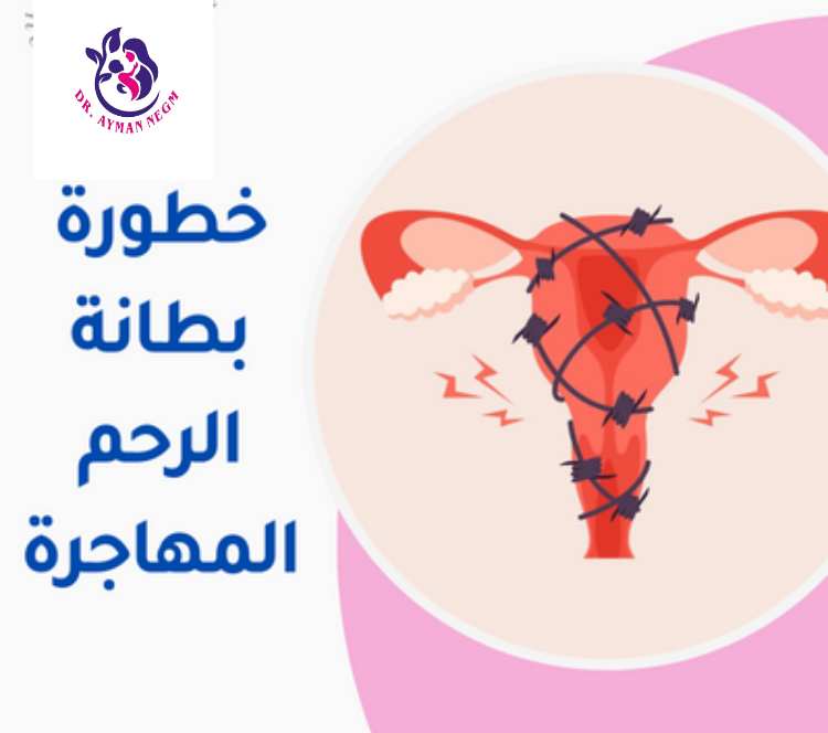 خطورة بطانة الرحم المهاجرة