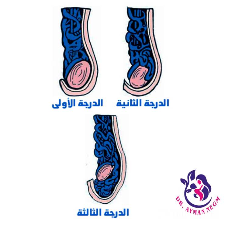 درجات دوالي الخصية