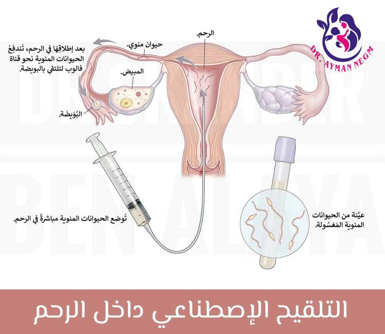 طريقة التلقيح الصناعي بالتفصيل