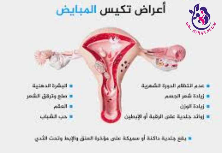 علاج تكيس المبايض الخفيف