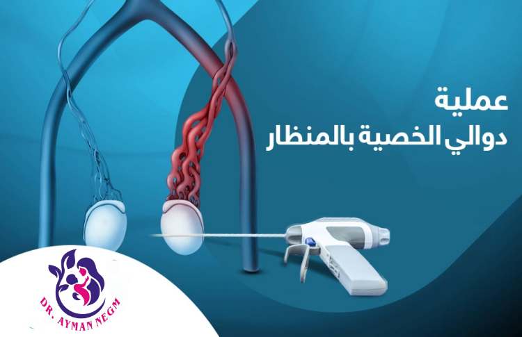 عملية دوالي الخصية بالمنظار