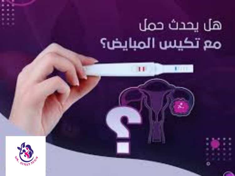 هل يحدث حمل مع تكيس المبايض الخفيف؟ 