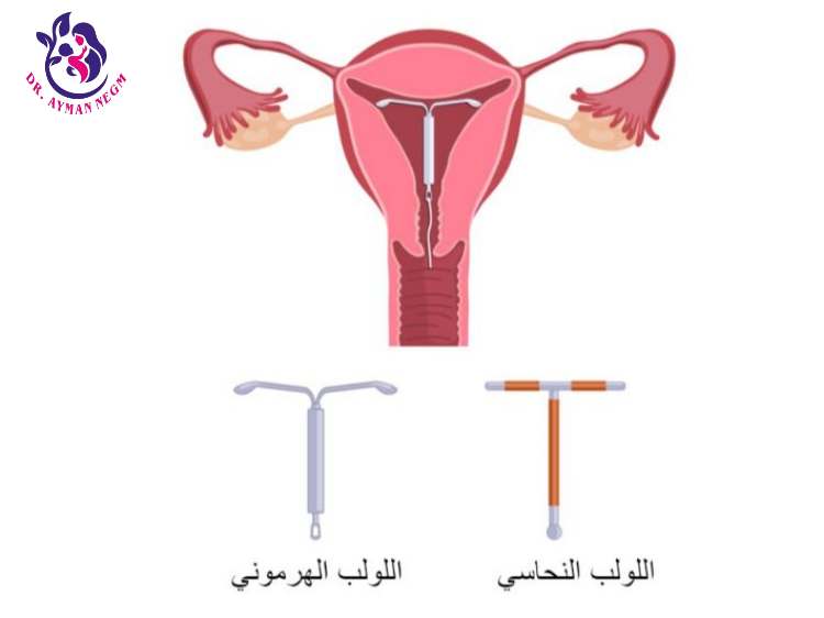 الفرق بين اللولب الهرموني والنحاسي 