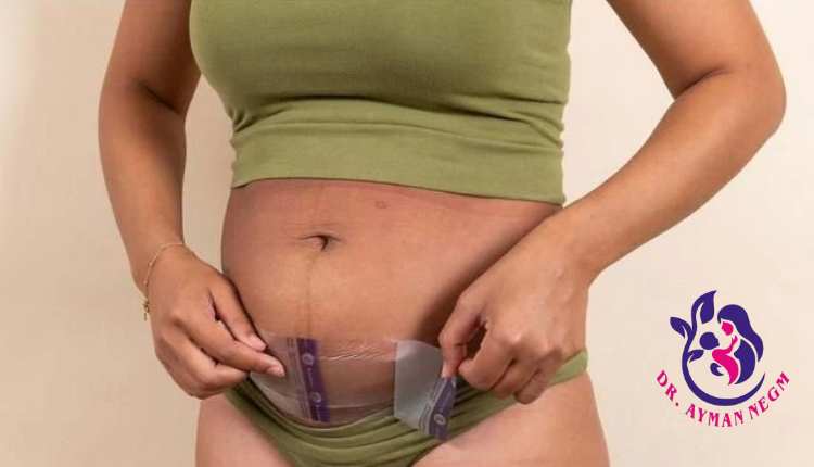 لاصقة الولادة القيصرية بدون ألم