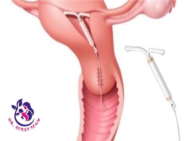 متى يتم تركيب اللولب 