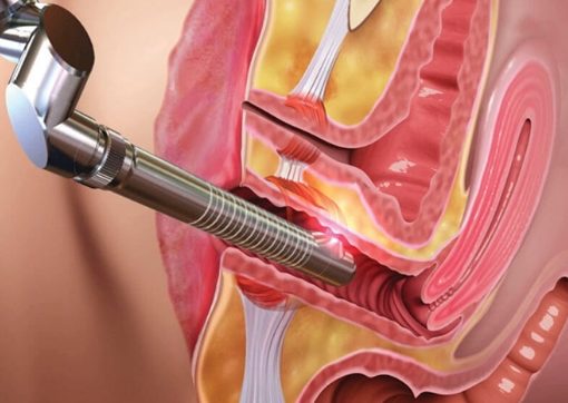 سعر عملية تضييق المهبل بالليزر