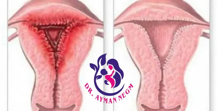 ما هو التهاب المهبل الخارجي​؟